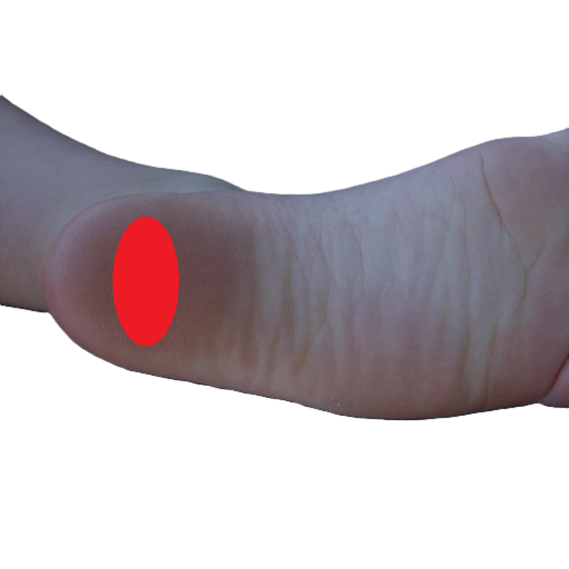 지방패드위축증후군 설명 이미지